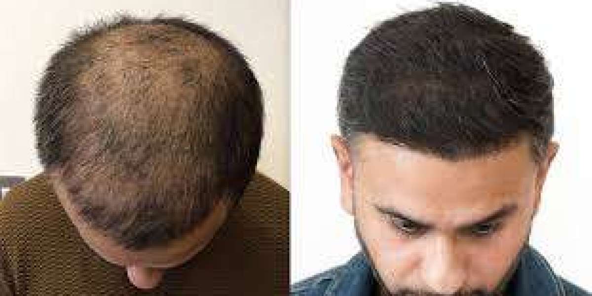 Is a hair transplant permanent? 