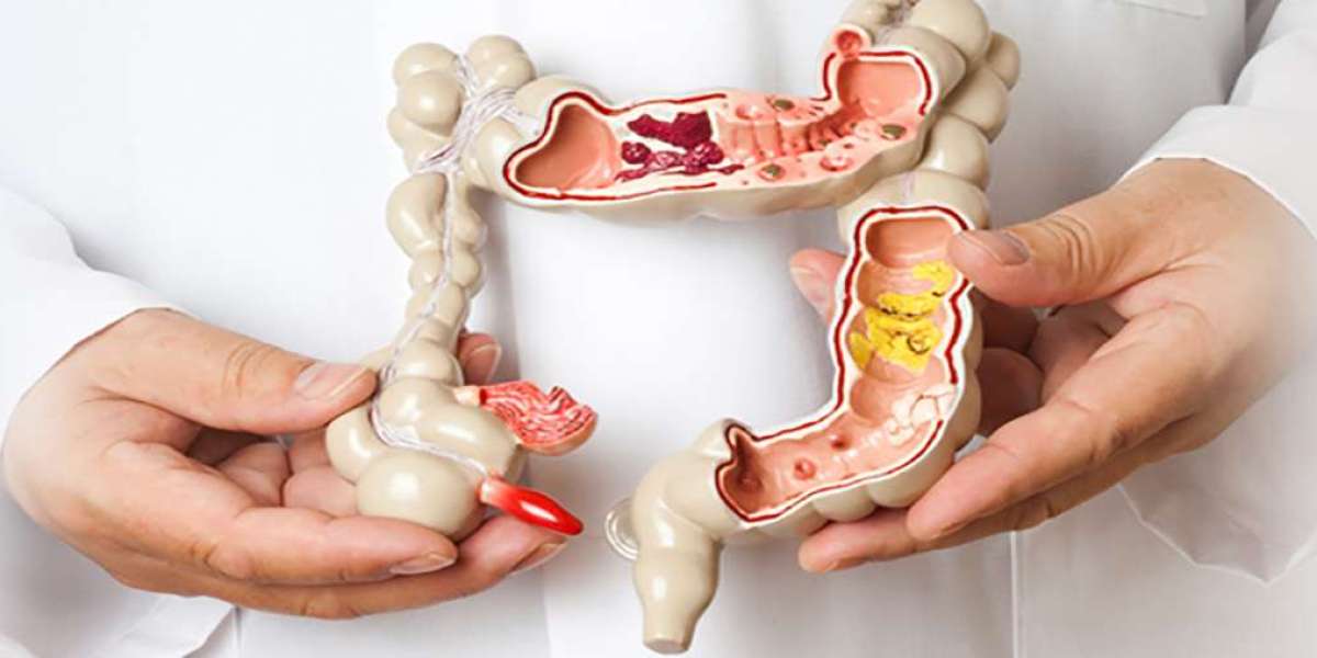 Your Ultimate Guide to Choosing the Best Colorectal Surgeon in Mumbai