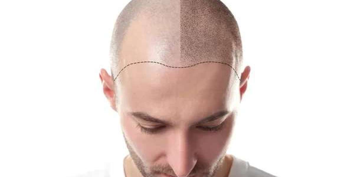 Hair Transplant Prices in Dubai: What You Should Know