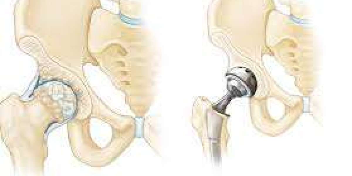 Top Joint Replacement Surgeons in Delhi: Expertise and Advanced Care for Restoring Mobility