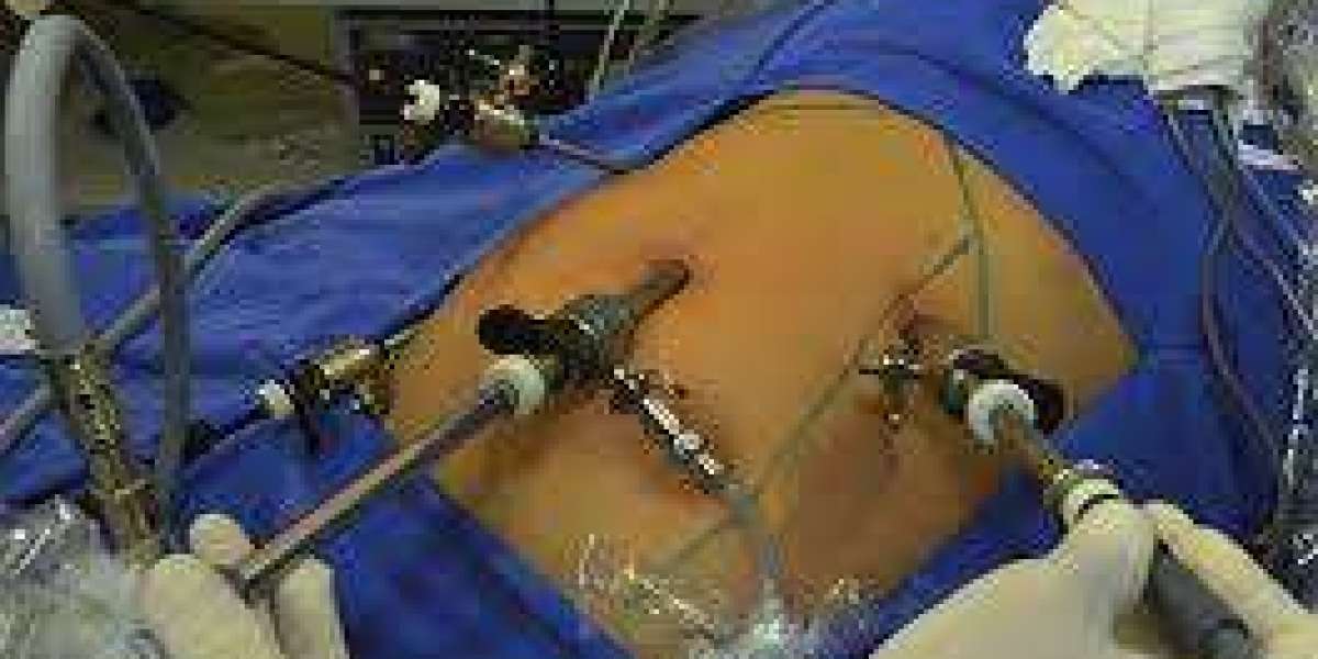 Advanced Laparoscopic Cholecystectomy Surgery in Pune: Safe and Effective Gallbladder Removal