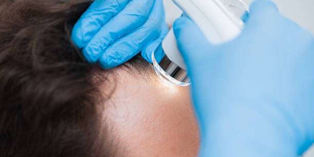 Top 4 Clinics with the Best Hair Transplant Cost in Jaipur