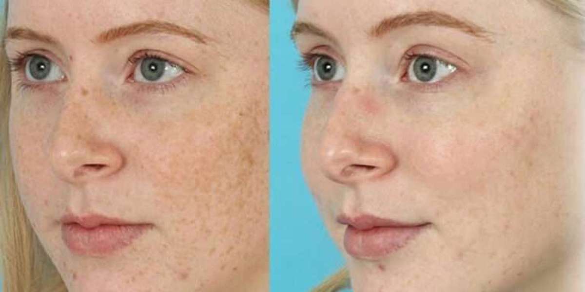 Morpheus8 RF Microneedling: The Ultimate Guide to Skin Rejuvenation