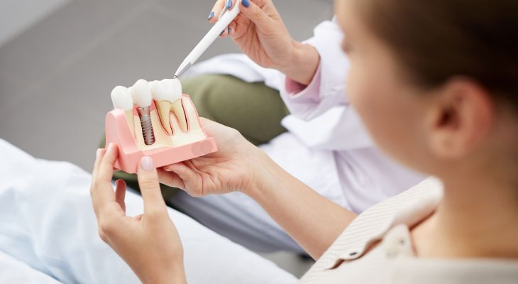 Everything You Need to Know About Dental Implants | Complete Guide