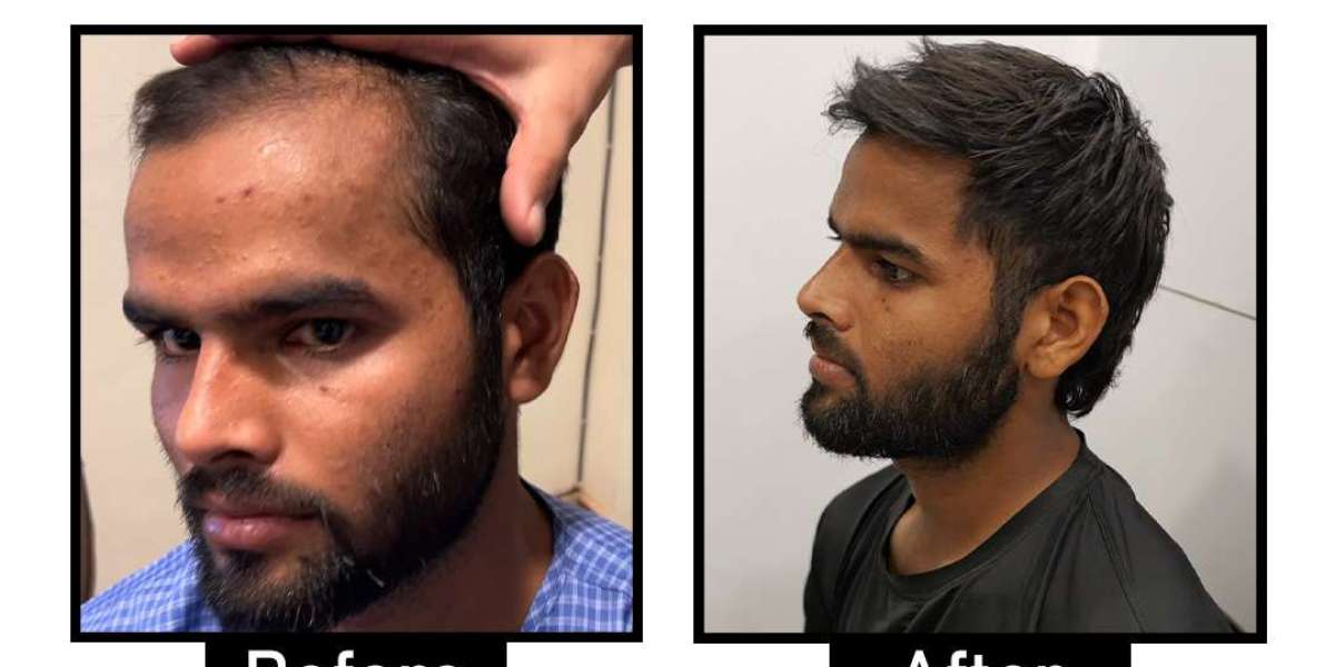 Affordable and Effective Hair Transplant in Delhi NCR