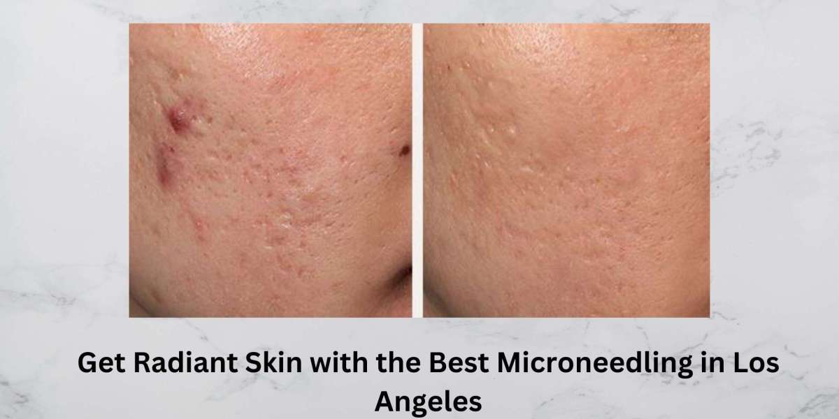 Get Radiant Skin with the Best Microneedling in Los Angeles