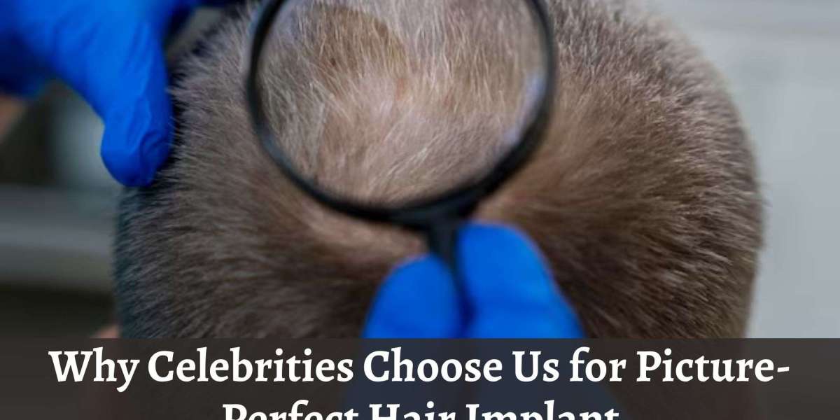 Why Celebrities Choose Us for Picture-Perfect Hair Implant