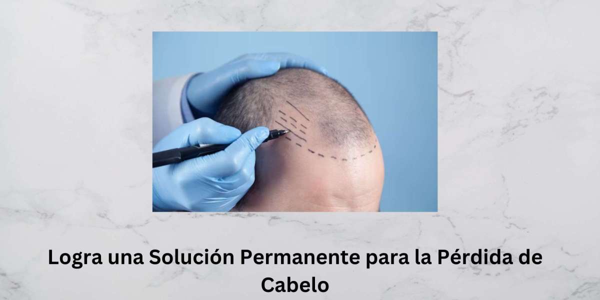 Logra una Solución Permanente para la Pérdida de Cabelo