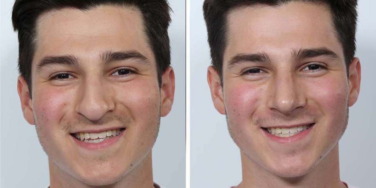 Great Rhinoplasty: A Guide to the Best Men’s Nose Job and Finding the Right Surgeon