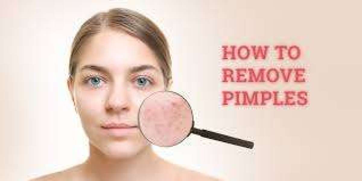 How Do You Get Rid of Pimples? A Complete Guide to Clear Skin