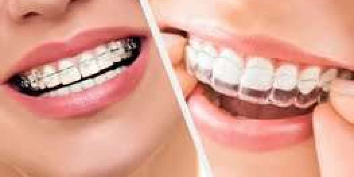 Why Choosing the Best Dentist for Braces in Bangalore Makes All the Difference