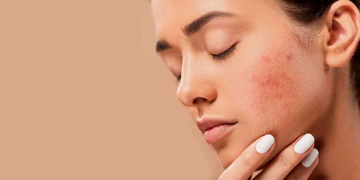 Get Clear Skin: Expert Tips on Acne Treatment Vienna