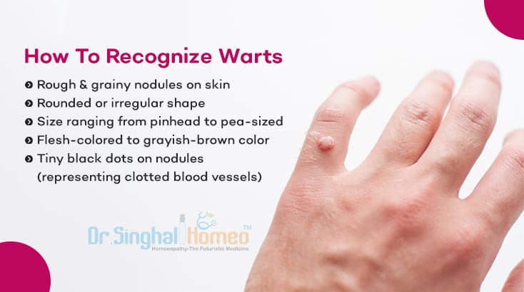 Common Warts Symptoms and Causes— An Overview