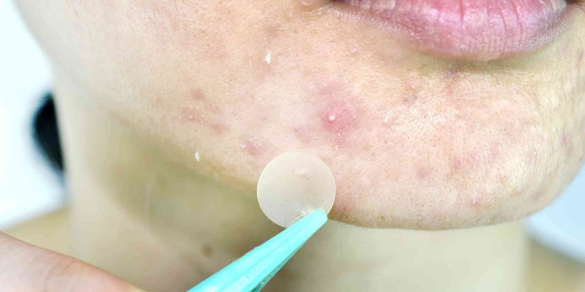 Hydrocolloid Acne Patch: A Revolutionary Solution for Acne Treatment