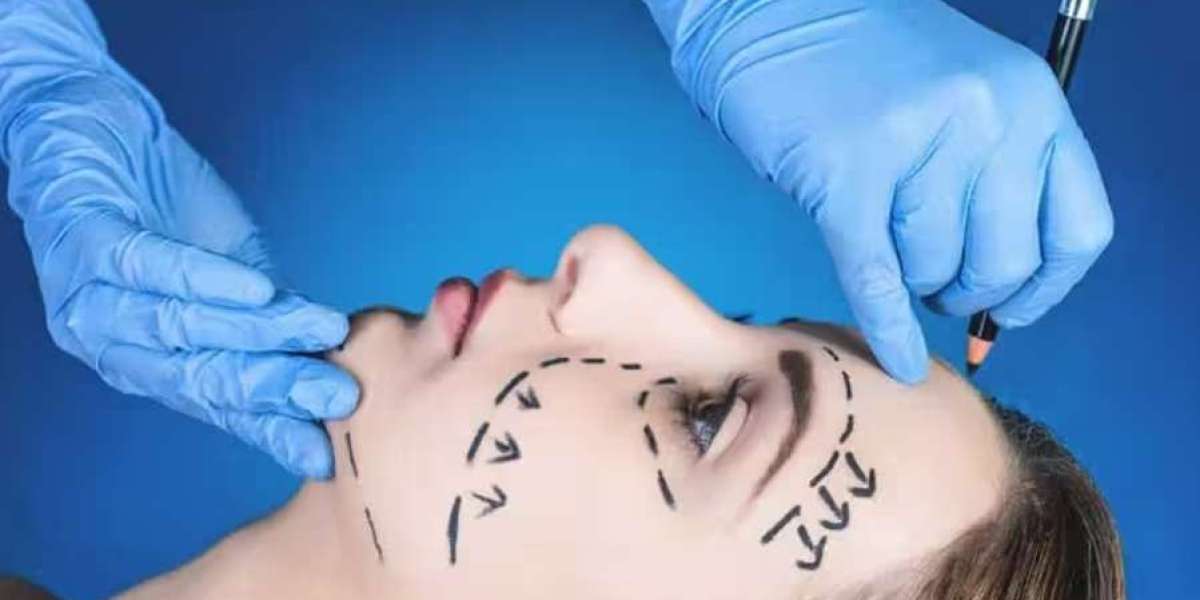 What Is Rhytidectomy Surgery? A Complete Guide to Facelifts