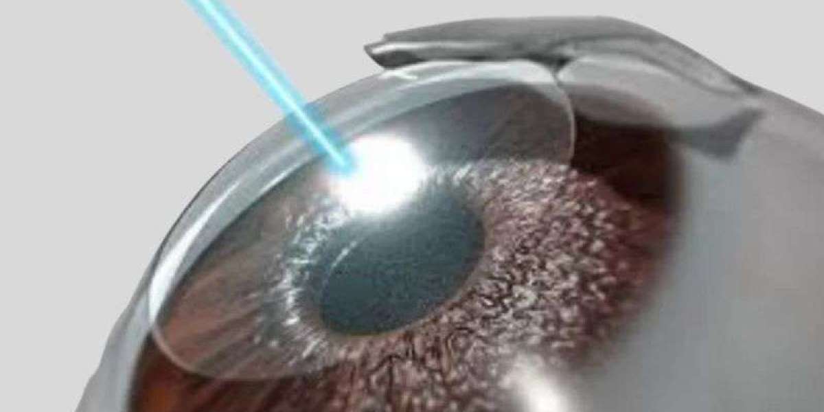 LASIK Eye Surgery in India: Everything You Need to Know