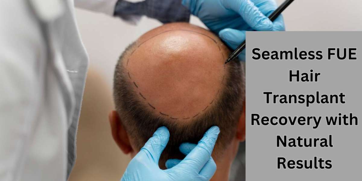 Seamless FUE Hair Transplant Recovery with Natural Results