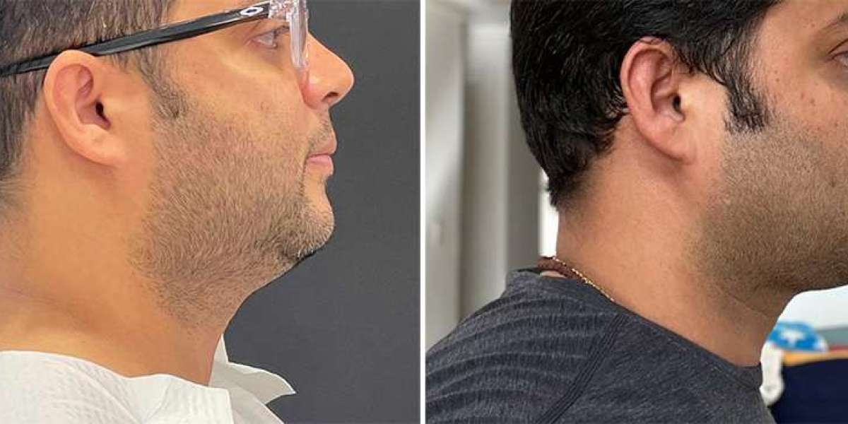 Reshape Your Jawline: Why Chin Liposuction Chicago Is Gaining Popularity