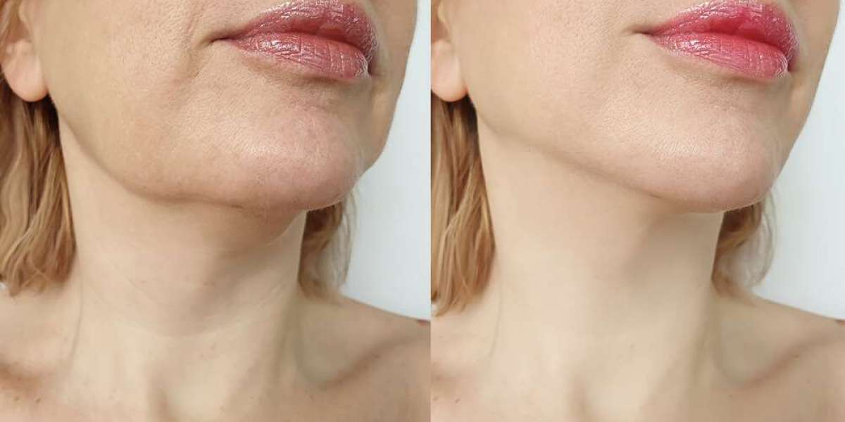 Say Goodbye to Double Chin with Chin Lipo Near You