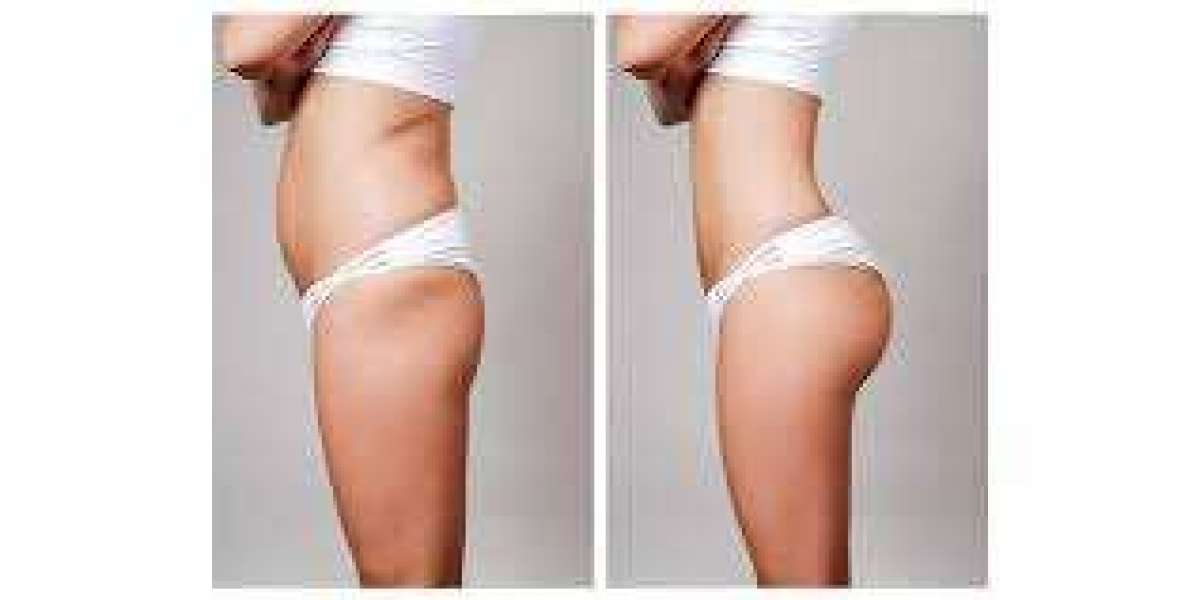 Non-Surgical & Surgical Butt Lift – Enhance Your Curves with Confidence