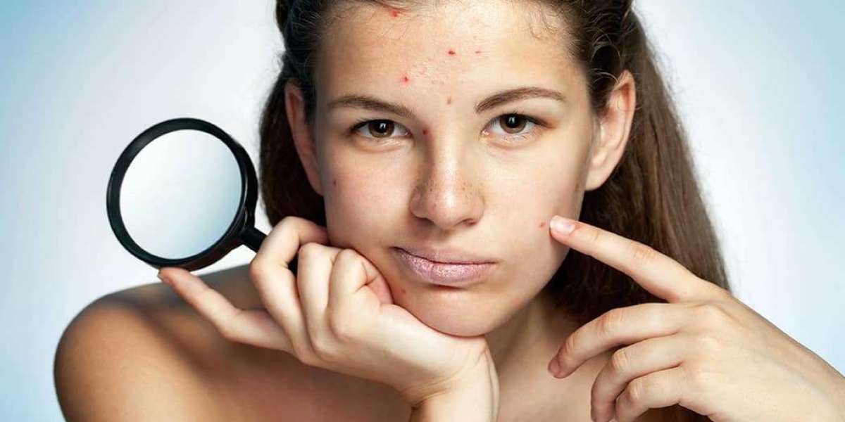 Say Goodbye to Acne: Your Ultimate Guide to a Crystal-Clear Lifestyle