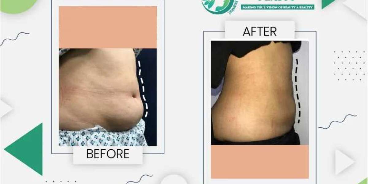 Liposuction in Lahore: Redefine Your Shape with Precision and Care