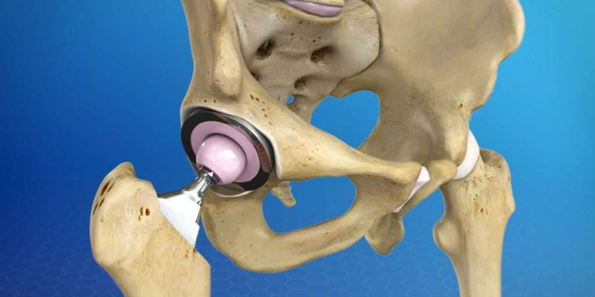 A Complete Guide to Hip Replacement Recovery Time