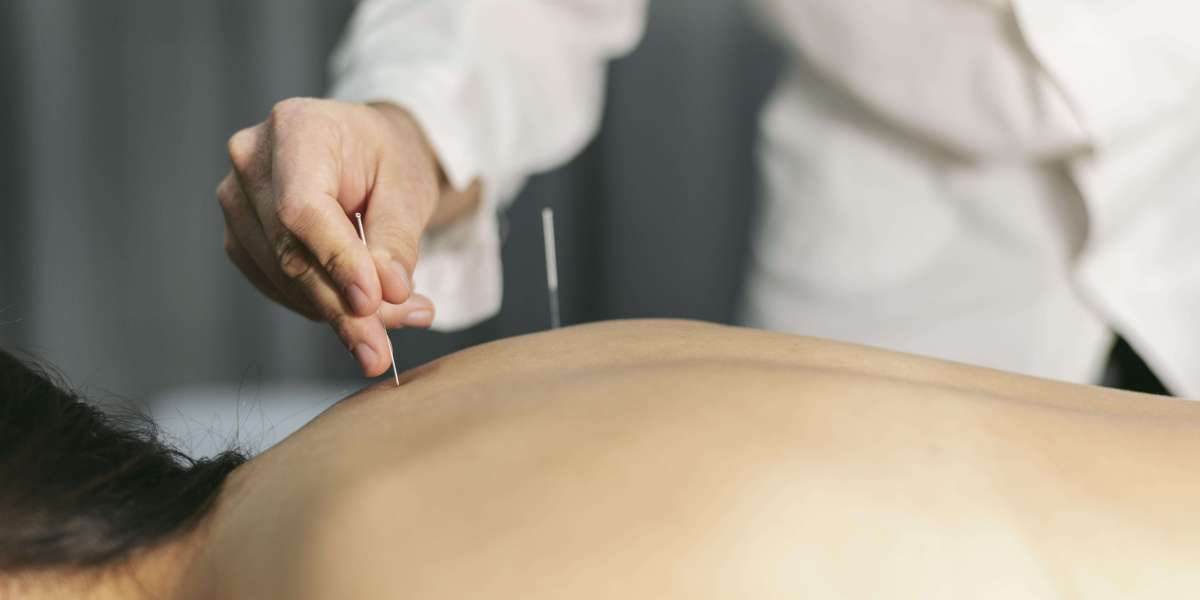 Experience the Healing Benefits of Acupuncture at Hannah Integrative Health in Newport Beach, CA